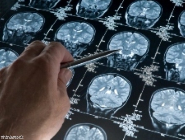 Brain technology could aid the recovery of stroke victims